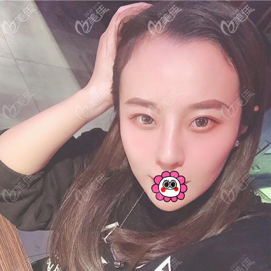 肋软骨隆鼻恢复半个月 肋软骨隆鼻恢复半个月