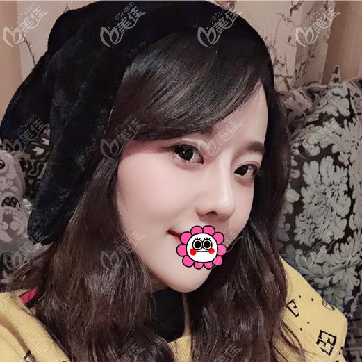 肋软骨隆鼻恢复两个月基本稳定 肋软骨隆鼻恢复两个月基本稳定