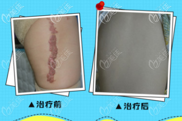 500多块的疤痕软化针和8800元的手术祛疤我们更应该选择哪一个呢