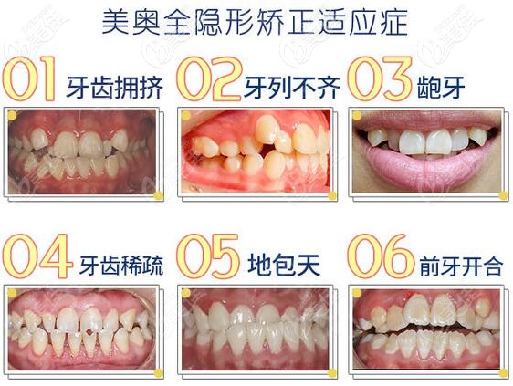 苏州美奥口腔正雅隐形矫正适应症 苏州美奥口腔正雅隐形矫正适应症