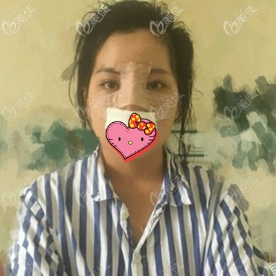 做完鼻部多项术后照