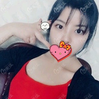 术后半个月效果分享