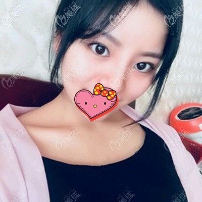 做完肋骨鼻1个月鼻子的变化