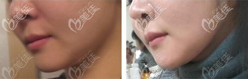 下颌缘吸脂术后效果