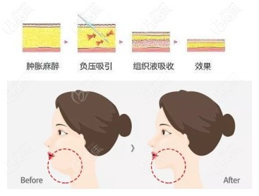 吸脂手术瘦下巴过程