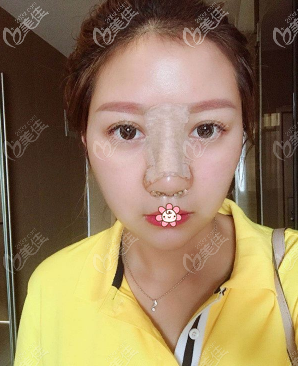 快拆线了 快拆线了