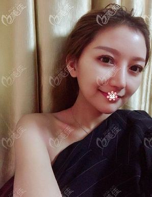 重庆好美隆鼻怎么样 重庆好美隆鼻怎么样