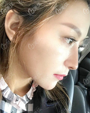 重庆好美毕胜肋软骨隆鼻术后半年图片 重庆好美毕胜肋软骨隆鼻术后半年图片