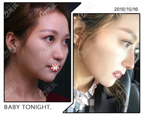重庆好美毕医生做鼻子可以，我做的肋软骨鼻综合半年后没钙化