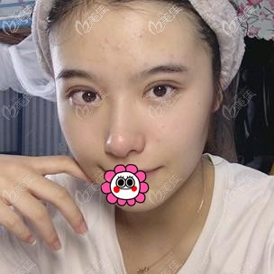 拆线后的双眼皮效果