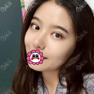 全切双眼皮术后恢复一个月效果