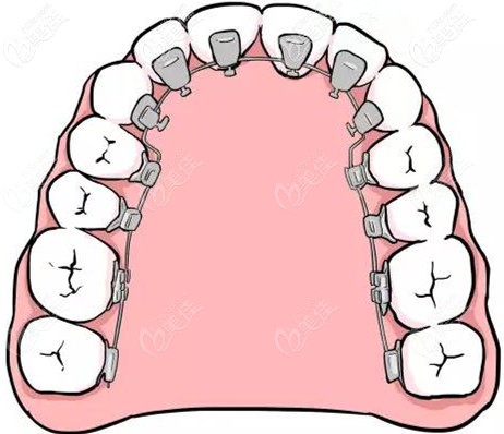 全隐形舌侧矫正器
