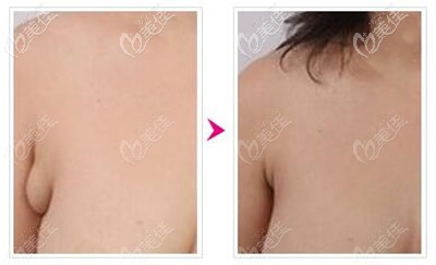 消除副乳的正确方法到底是吸脂好还是割掉好 除了价格还得考虑手术效果 整形行业新闻话题 美佳网