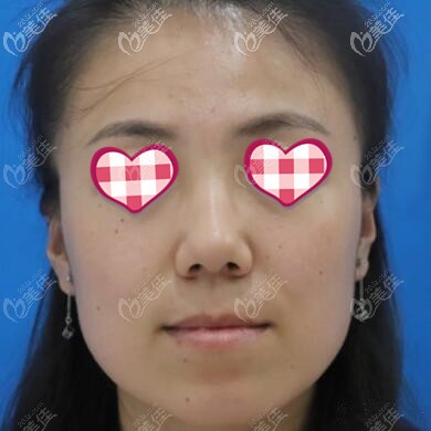 做埋线提升术前照 做埋线提升术前照