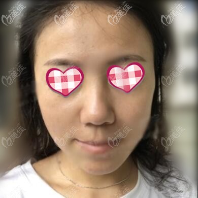 面部年轻化术后第3天效果 面部年轻化术后第3天效果