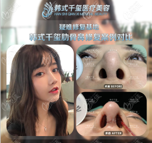 广州韩 式千玺肋软骨隆鼻失败修复案例对比图