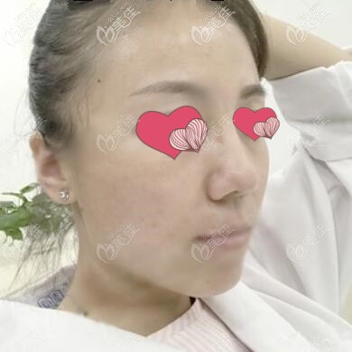 面部提升术后一周效果照 面部提升术后一周效果照