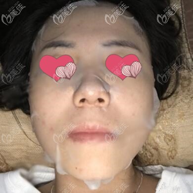 面部埋线提升术后半个月效果照 面部埋线提升术后半个月效果照