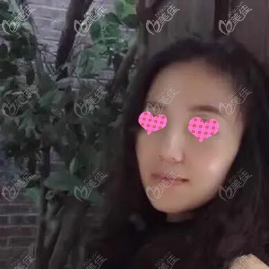 做面部埋线提升术后40天效果照 做面部埋线提升术后40天效果照