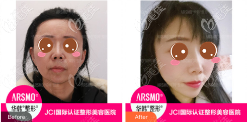 北京华韩柳民熙3D面部提升真人案例对比