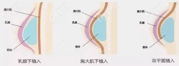 假体隆胸常见的几种位置