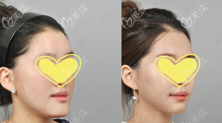 韩国id医院无矫正双鄂手术真人案例效果对比图