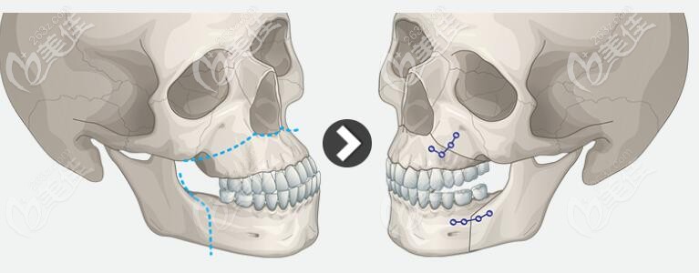 韩国id医院无矫正双鄂手术优势
