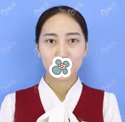 祛眼袋手术前的我 祛眼袋手术前的我