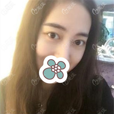 术后20天的样子 术后20天的样子