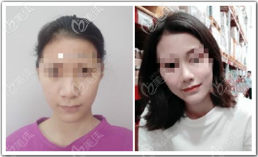 我找昆明吴氏嘉美庄蔚强院长做鼻综合四项效果对比图 我找昆明吴氏嘉美庄蔚强院长做鼻综合四项效果对比图