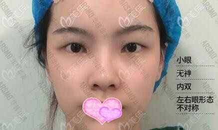 ARSMO潘多拉全眼综合术前照 ARSMO潘多拉全眼综合术前照