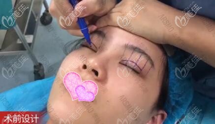 术前画线设计 术前画线设计