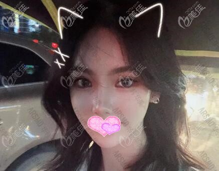 ARSMO潘多拉全眼综合术后20天效果照 ARSMO潘多拉全眼综合术后20天效果照