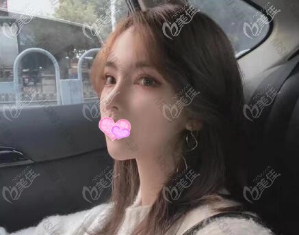 做ARSMO潘多拉全眼综合术后一个月的恢复效果照 做ARSMO潘多拉全眼综合术后一个月的恢复效果照