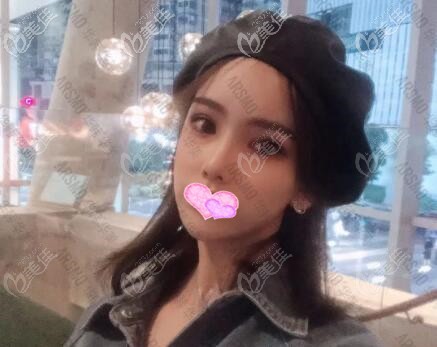 做ARSMO潘多拉美眼术后45天恢复效果照 做ARSMO潘多拉美眼术后45天恢复效果照