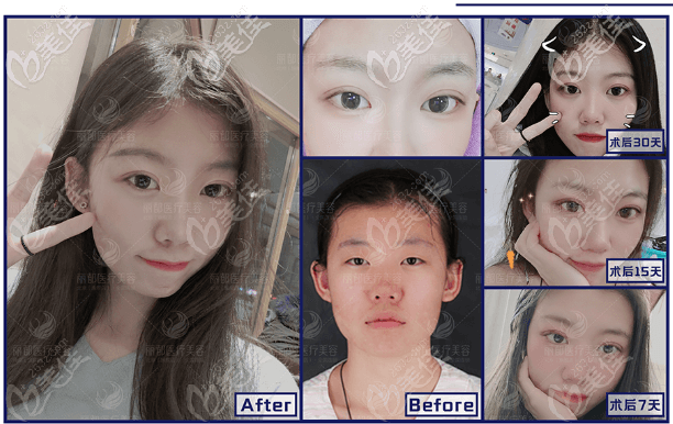 北京米兰柏羽丽都曹卫华做眼睛怎么样?8度美瞳术双眼皮案例效果展示 北京米兰柏羽丽都曹卫华做眼睛怎么样?8度美瞳术双眼皮案例效果展示