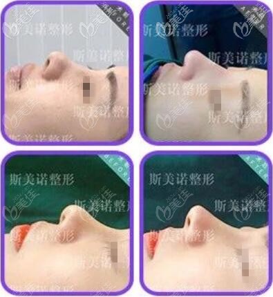 斯美诺鼻部整形真人前后对比效果照 斯美诺鼻部整形真人前后对比效果照