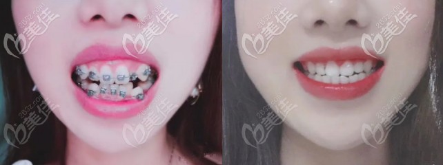 女生有颗虎牙长歪了往外翘，摘下日本TOMY自锁金属托槽后着实令人惊叹！