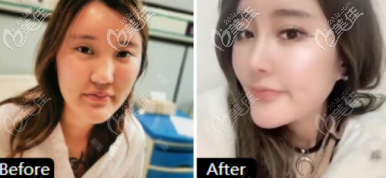 如果你是淄博的妹子不知道如何选隆鼻医院，那就来看看这三个案例吧