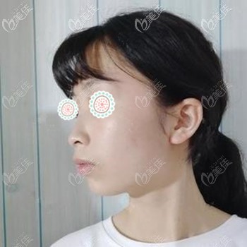 做肋骨鼻前的鼻型问题 做肋骨鼻前的鼻型问题