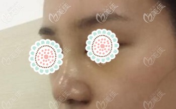 做肋软骨隆鼻后的一个月 做肋软骨隆鼻后的一个月