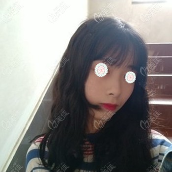 做肋软骨隆鼻后鼻梁高挺 做肋软骨隆鼻后鼻梁高挺