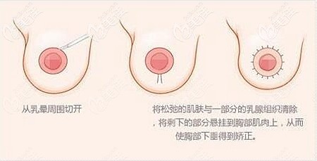 双环法乳房下垂矫正手术 双环法乳房下垂矫正手术