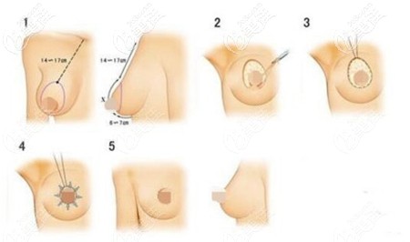 乳房塑形悬吊法 乳房塑形悬吊法