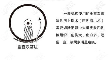 垂直双蒂法胸下垂矫正 垂直双蒂法胸下垂矫正