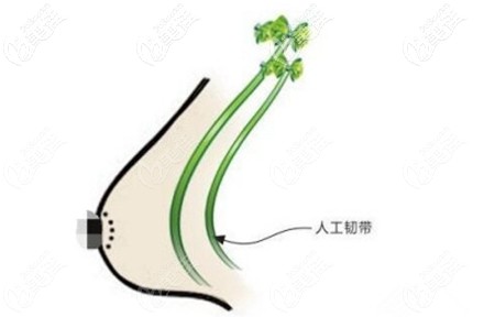 人工韧带乳房上提术 人工韧带乳房上提术