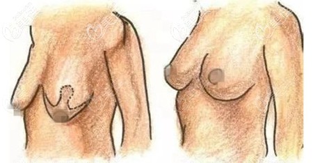 乳房悬吊术后疤痕照片 乳房悬吊术后疤痕照片