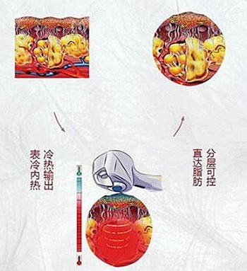 BTL射频溶脂的原理