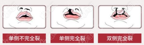 兔唇等级划分 兔唇等级划分