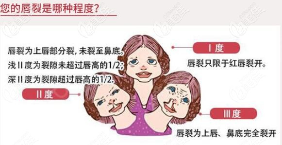唇裂程度细分示意图 唇裂程度细分示意图